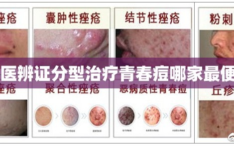 中医辨证分型治疗青春痘哪家最便宜